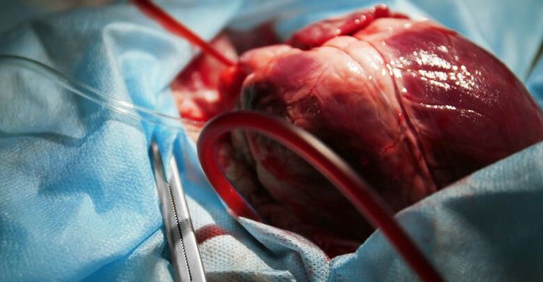 تعویض دریچه قلب از طریق آنژیوگرافی در یزد