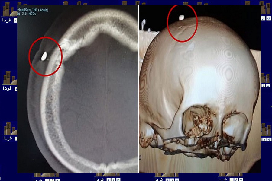 جا ماندن یک دندان در جمجمه پسر 14 ساله پس از گاز گرفتنش در فوتبال+ تصویر