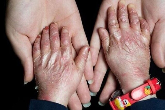 بیشترین بیماران پروانهای استان کرمان در کدام منطقه هستند؟