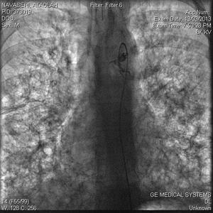 درمان قطع خونریزی ریوی و مجراى تنفسى از طریق پوست